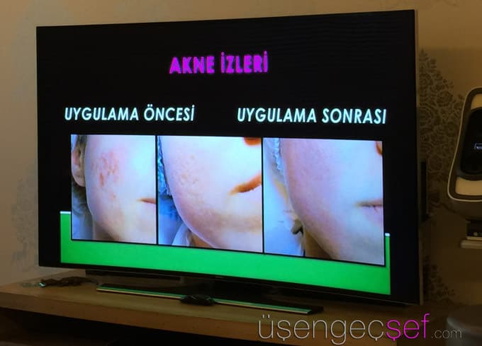 dr-huseyin-tirman-akne-tedavisi