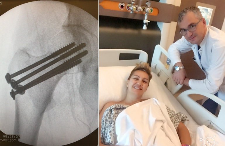 dr-erden-erturer-ortopedi-kalca-femur-kirigi